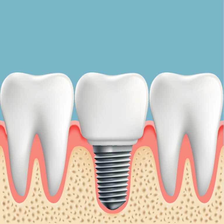 Quali sono gli impianti dentali migliori?