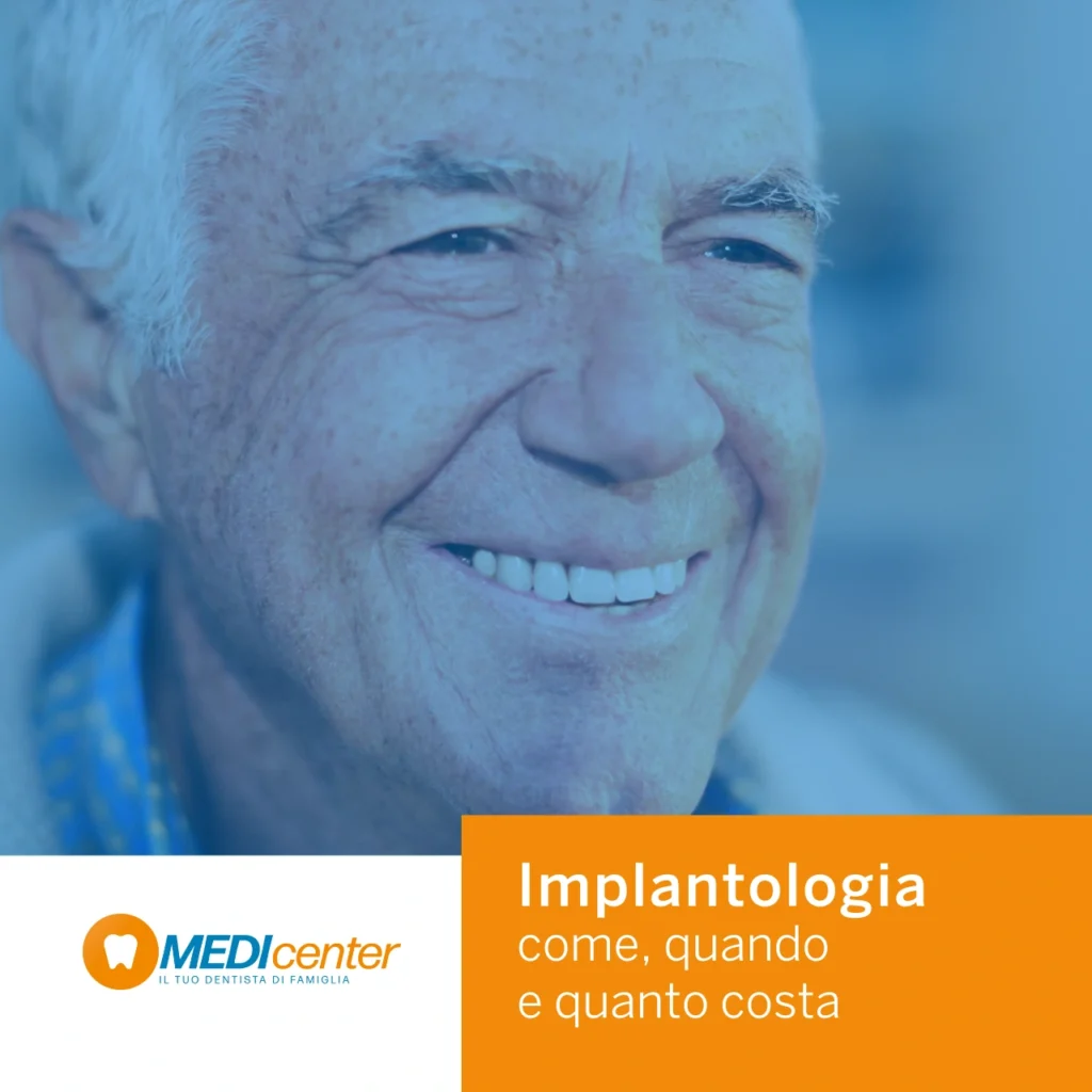 Implantologia, come quando e quanto costa