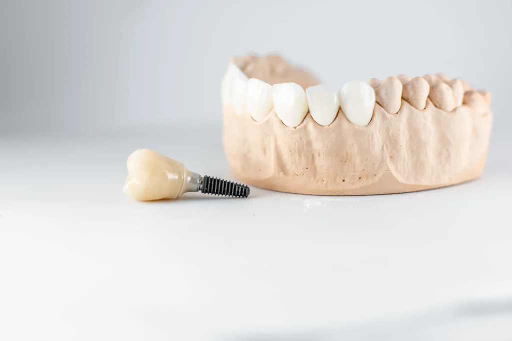 Tempistiche per un impianto dentale: quanto tempo serve per tornare a sorridere? 2 Tempistiche impianto dentale