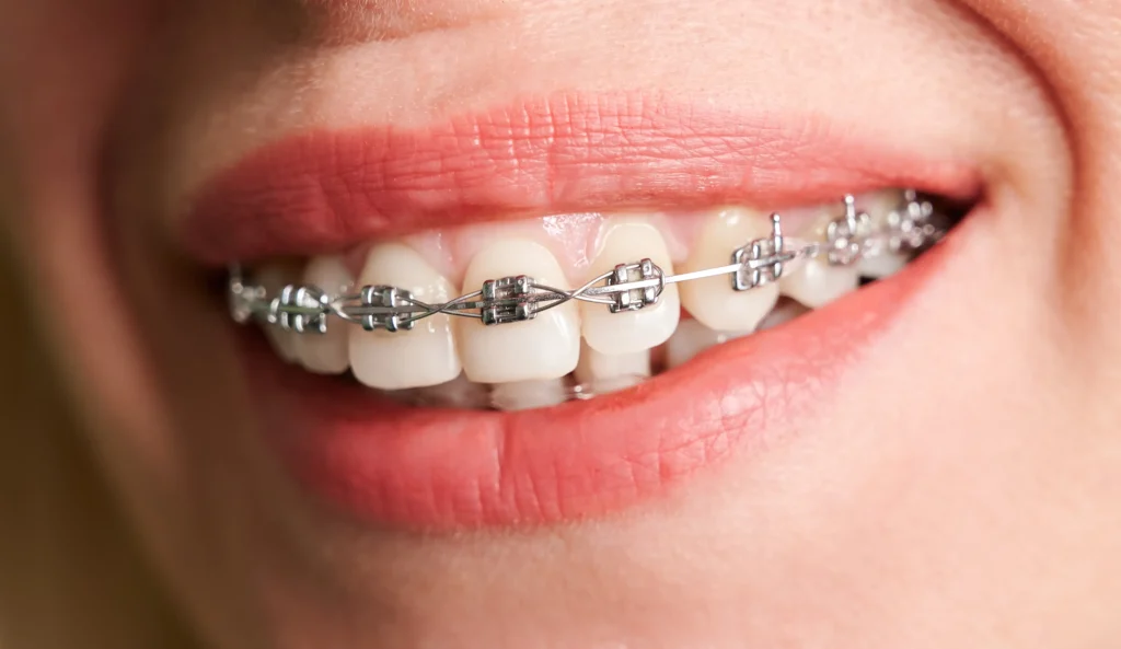 Quanto costa l’apparecchio per i denti