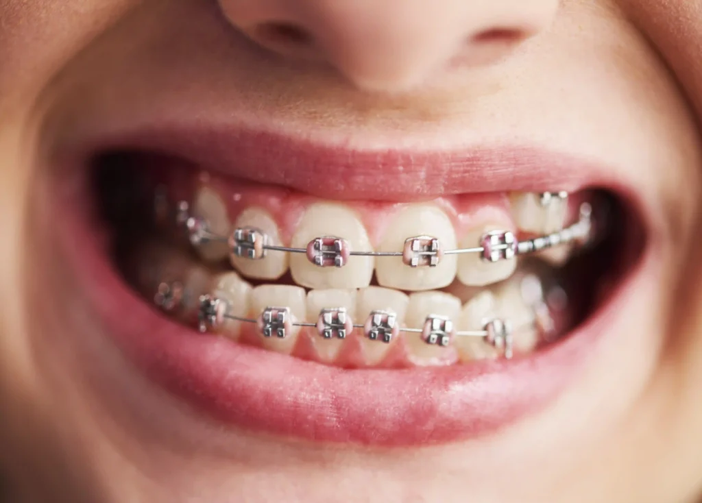 Quanto costa l’apparecchio per i denti